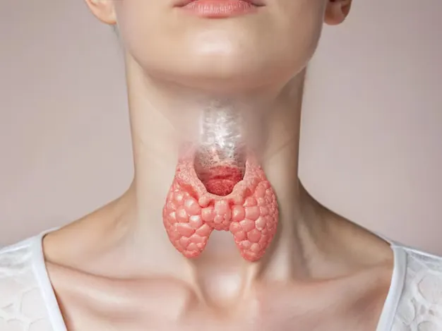 Ilustración de bocio con aumento de tamaño de la glándula tiroides en el cuello