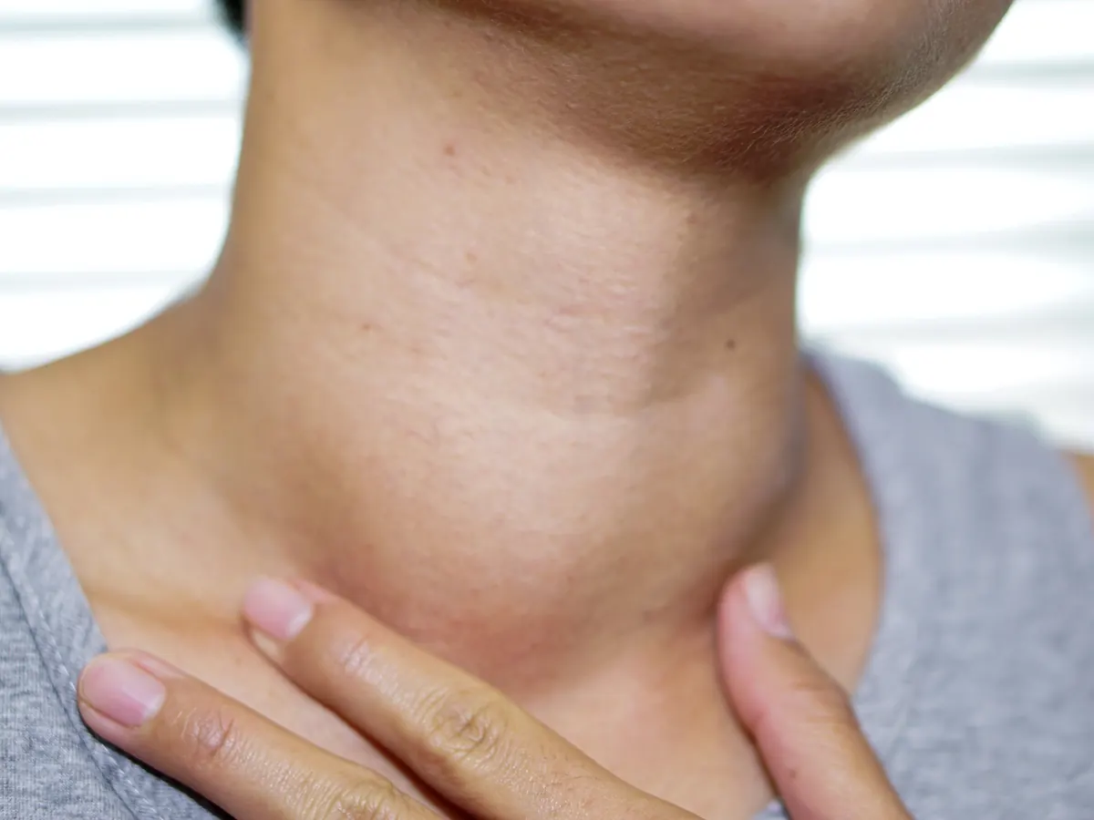 Ganglios del cuello Persona con molestia en el cuello por ganglios cervicales inflamados