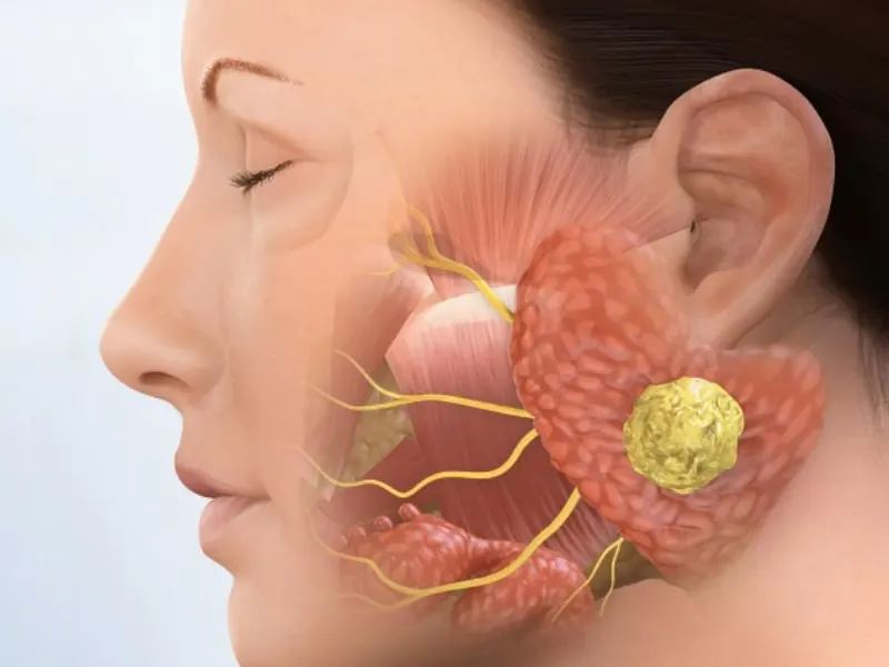 Ilustración de tumor de parótida y nervio facial para parotidectomía