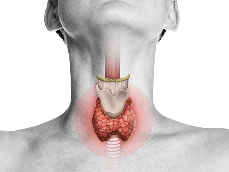 Ilustración de la glándula tiroides en el cuello para tratamiento de nódulos con radiofrecuencia