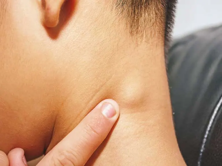 Tumores de cuello Persona palpando un tumor en el cuello